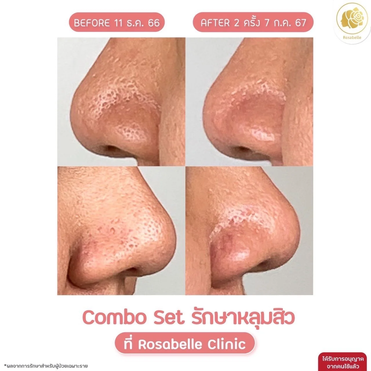 รีวิวโปรแกรม Combo Set บริเวณจมูก