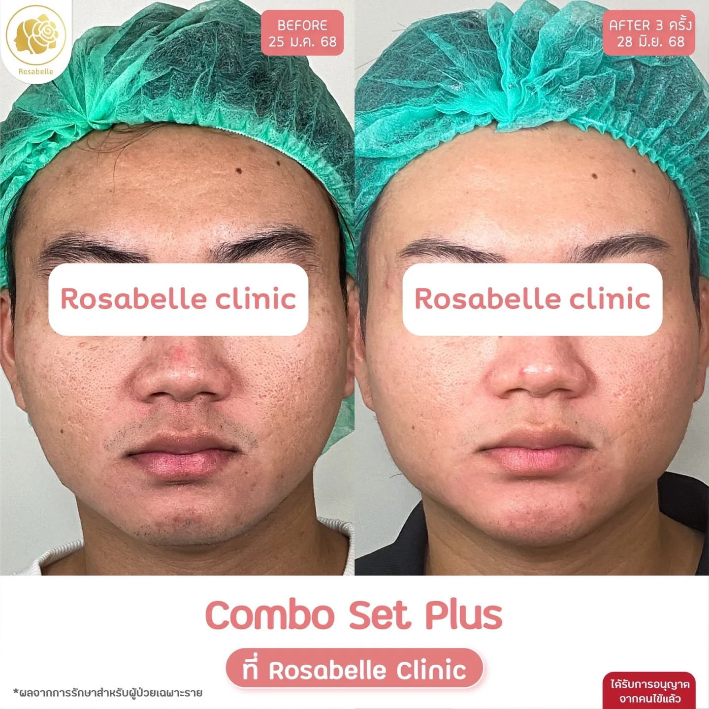 รีวิวโปรแกรม Combo Set Plus+