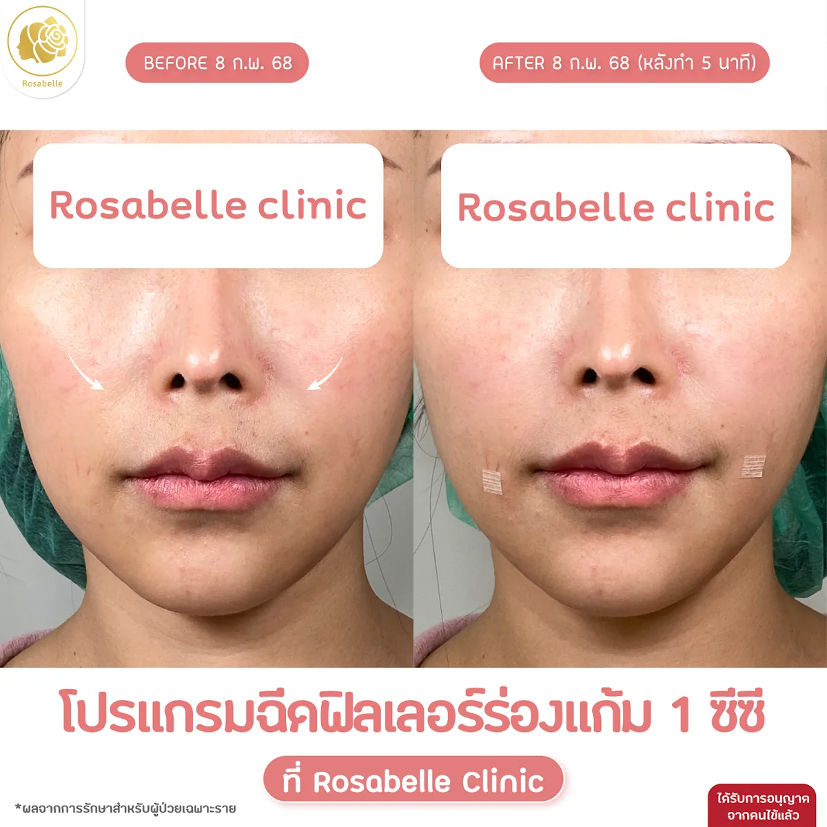 รีวิวโปรแกรมฟิลเลอร์ร่องแก้ม