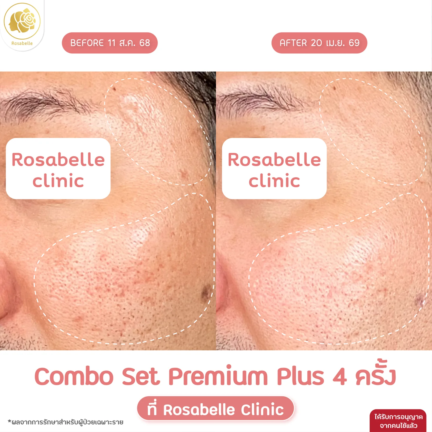 รีวิวโปรแกรม Combo Set Premium Plus+